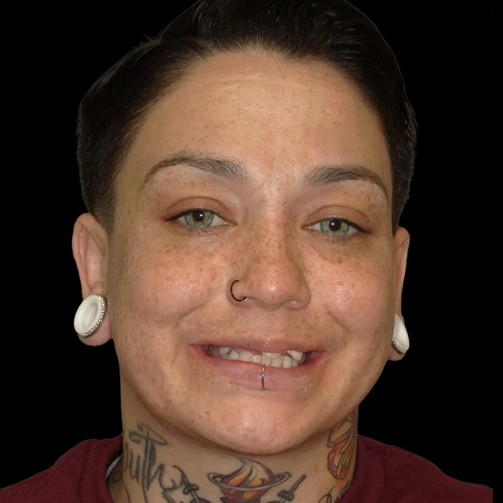 Before Single Day Treatment